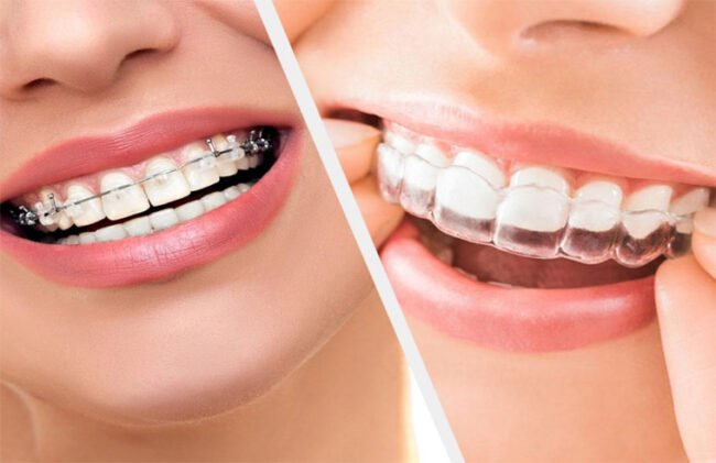 Invisalign or Braces