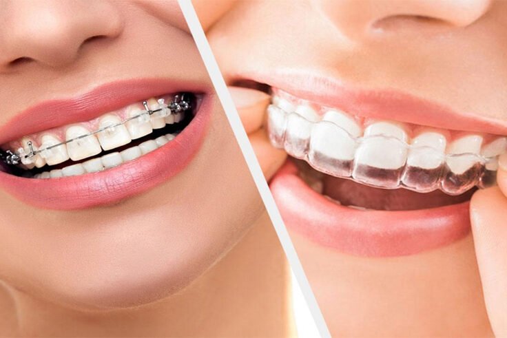 Braces Invisalign or Braces
