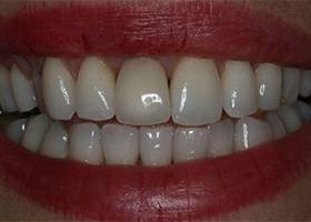 denta imlant after1