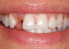 denta imlant before.