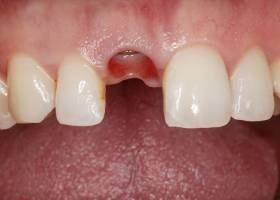 denta imlant before