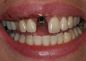 denta imlant before1