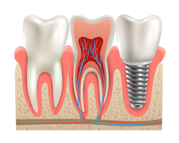 dental-implants-in-pune