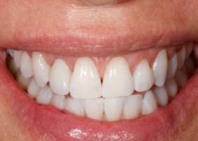 dental implants after.
