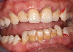gum care before.