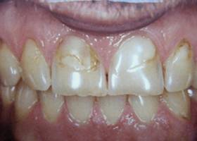 gum care before1