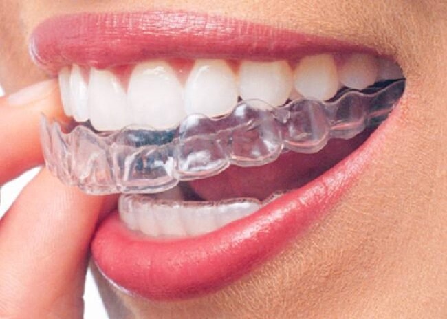 invisalign invisalign