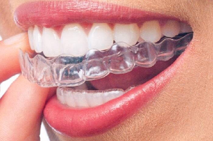 invisalign invisalign