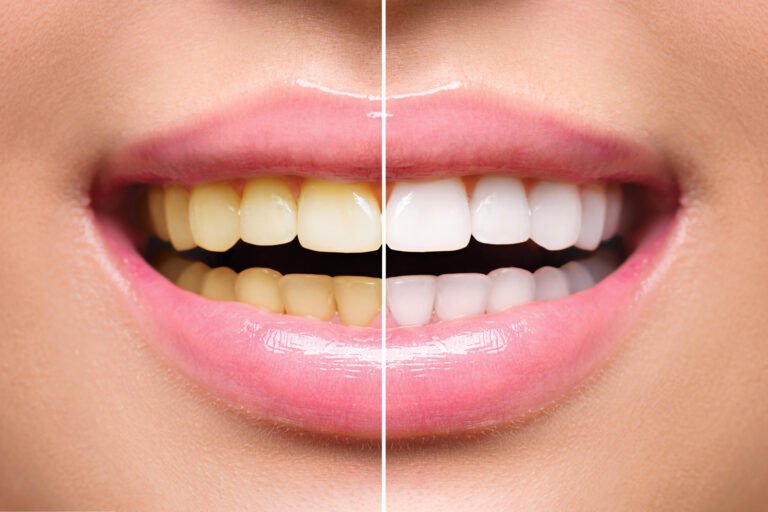 teeth-whitening teeth whiting