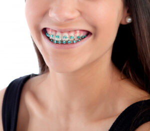 girl having braces in teeth
