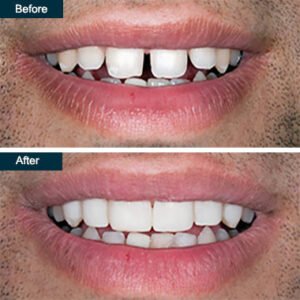 Dental Bonding treatment