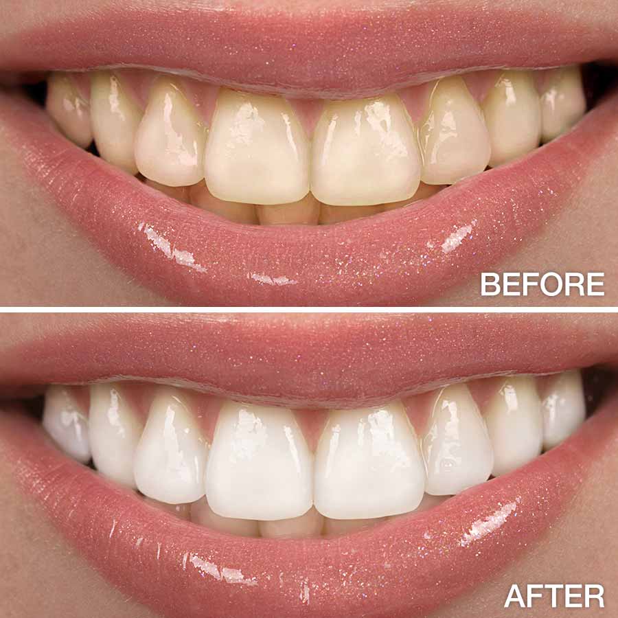 Teeth Whitening treatment in Pune