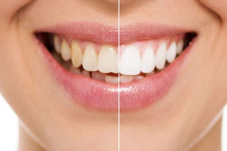 Teeth Whitening in Pune Teeth-Whitening-in-Pune