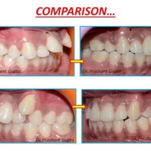 Braces treatment result