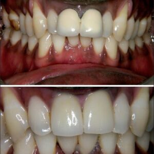 Teeth Whitening result 2
