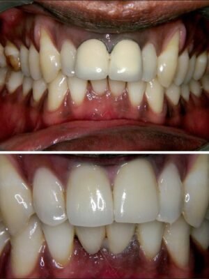 Teeth Whitening result 2