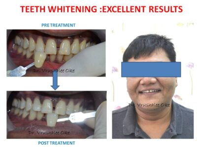 teeth whitening results