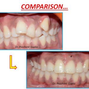 braces result