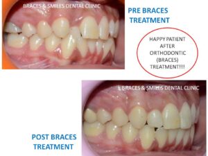 bracess treatment