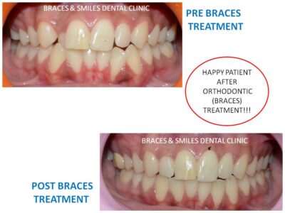 bracess treatment1