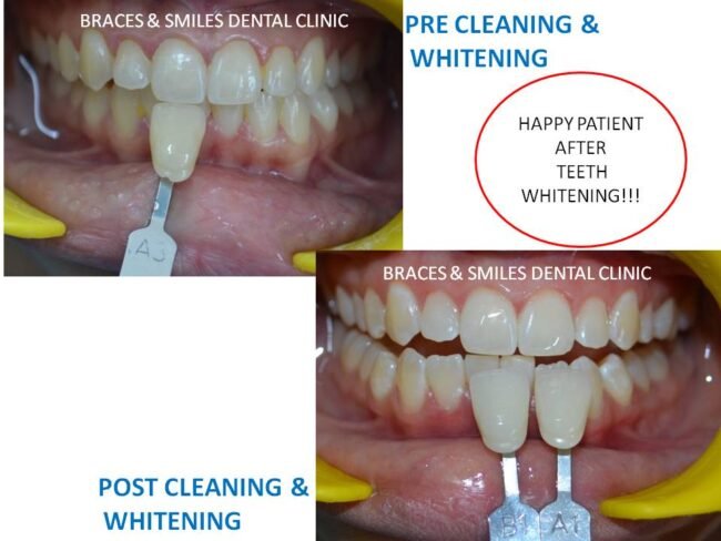 cleaning and whitening cleaning and whitening