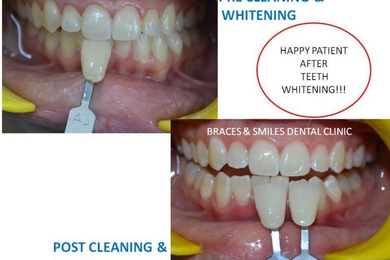 cleaning and whitening cleaning and whitening