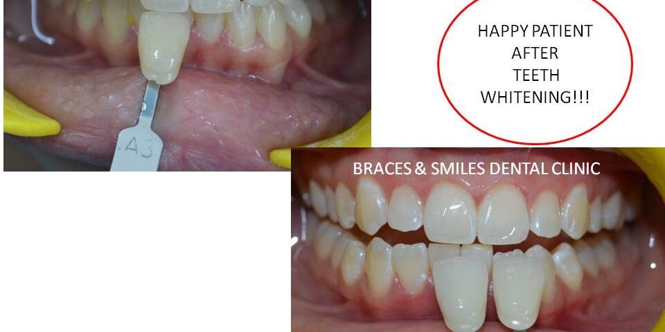 cleaning and whitening cleaning and whitening