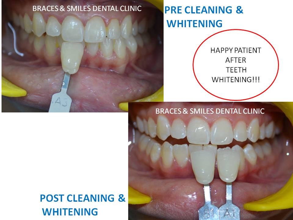 cleaning and whitening