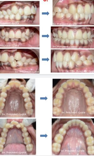 Root Canal Treatment in Kalyani Nagar