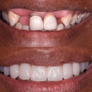 Invisalign or Braces