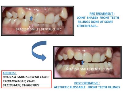 tooth-filling-bracessmile