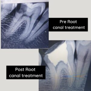 best root chanal treatment