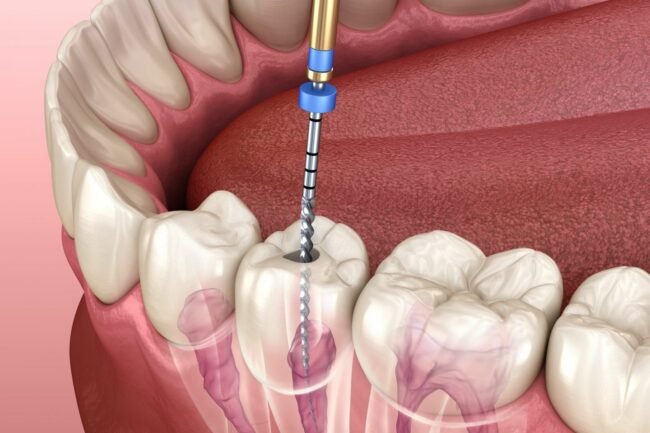 Root-Canal-Treatment root canal