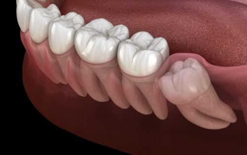 Wisdom Tooth Removal