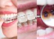 Invisalign or Braces