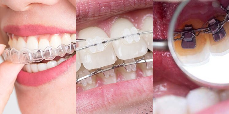 Invisalign or Braces Invisalign or Braces