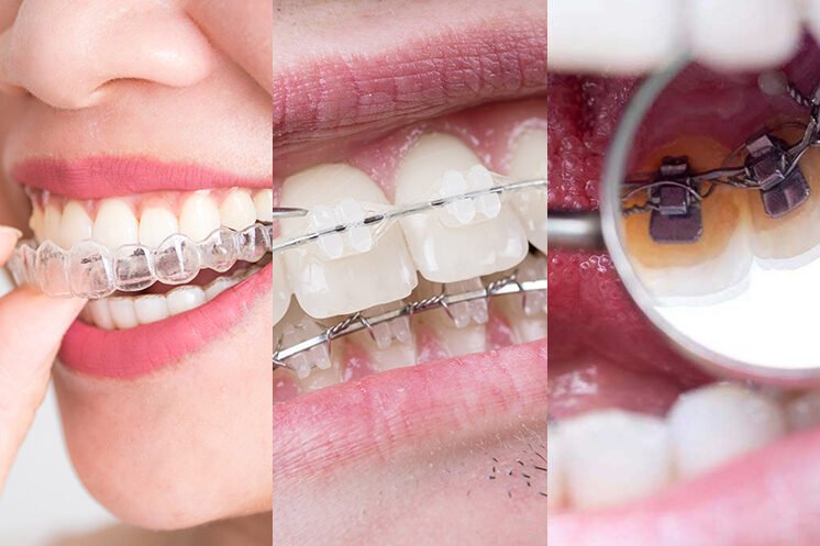 Invisalign or Braces Invisalign or Braces