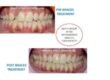 Best orthodentist treatment in Pune by Braces and Smiles