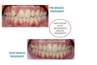 Best orthodentist treatment in Pune by Braces and Smiles Best orthodentist treatment in Pune by Braces and Smiles