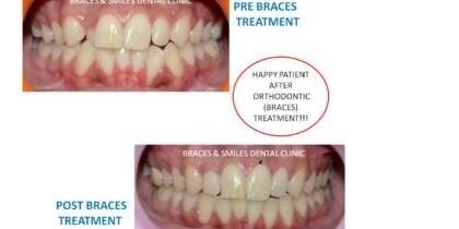 Best orthodentist treatment in Pune by Braces and Smiles