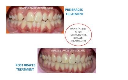 Best orthodentist treatment in Pune by Braces and Smiles Best orthodentist treatment in Pune by Braces and Smiles
