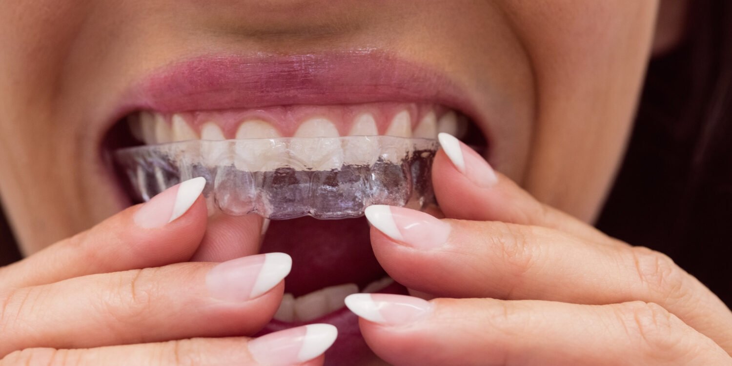 invisalign treatment in viman nagar at braces and smiles clinic