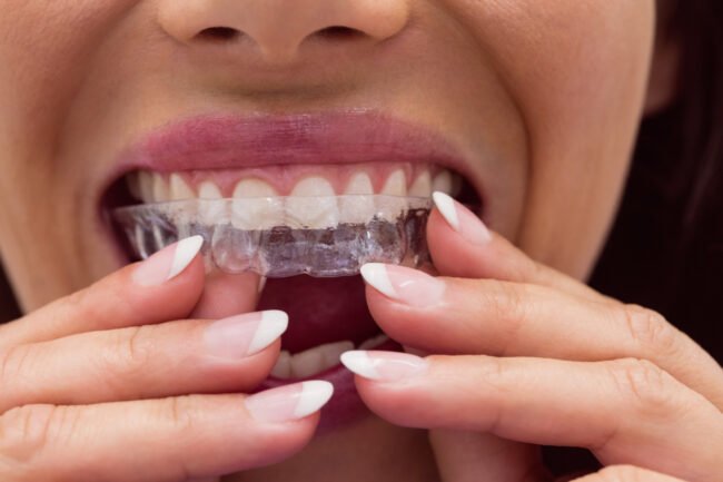 invisalign treatment in viman nagar at braces and smiles clinic
