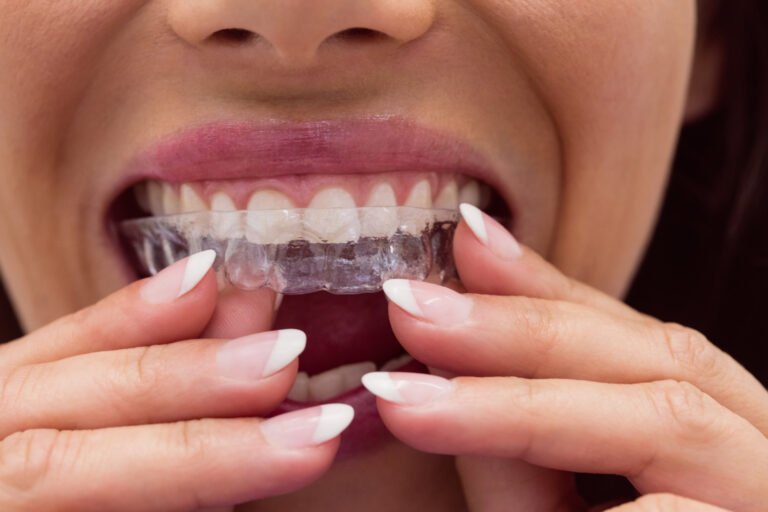 invisalign treatment in viman nagar at braces and smiles clinic invisalign treatment in viman nagar at braces and smiles clinic