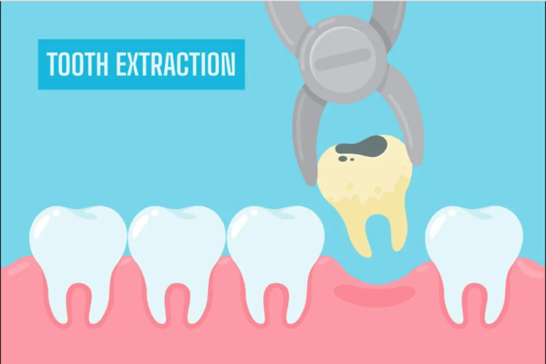 Tooth Extraction in pune Emergency Tooth Extraction: What You Need to Know