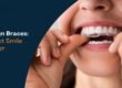 Aligners vs. Braces in Pune – Which is Better? A Perspective from Braces & Smiles