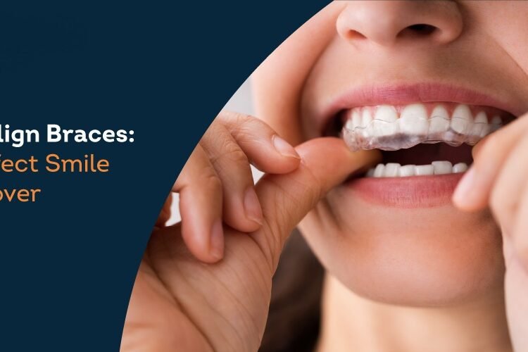 Aligners vs. Braces in Pune – Which is Better? A Perspective from Braces & Smiles