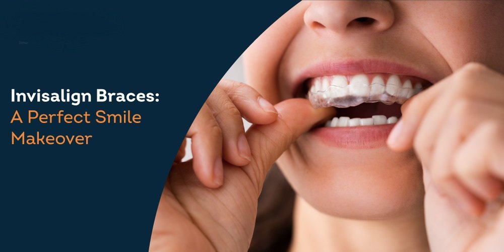 Invisalign-Braces-A-Perfect-Smile-Makeover Aligners vs. Braces in Pune – Which is Better? A Perspective from Braces & Smiles