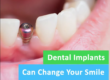 Transform Your Smile with the Best Dental Implants in Pune at Braces & Smiles