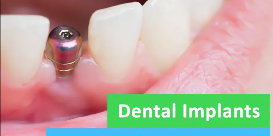Transform Your Smile with the Best Dental Implants in Pune at Braces & Smiles
